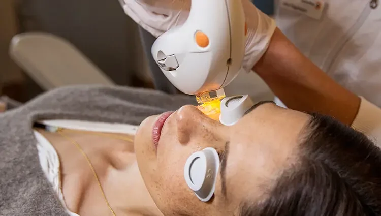 Patientin mit weißen Schutzschilden über den Augen bei einer IPL-Behandlung: Eine Hand mit weißem Handschuh führt eine leuchtende Sonde an die Haut an der Nase